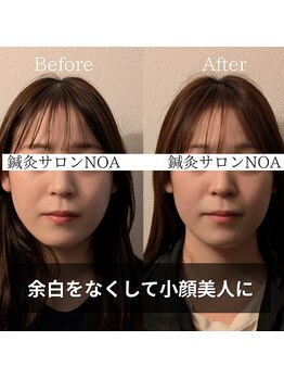 ノア(NOA)/ビフォーアフター