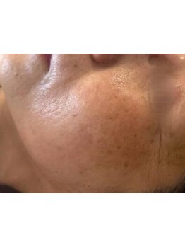 シミしわ改善！予防ケア