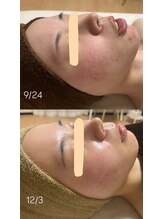 サロンモア(salon More)/陶肌トリートメン＋LED