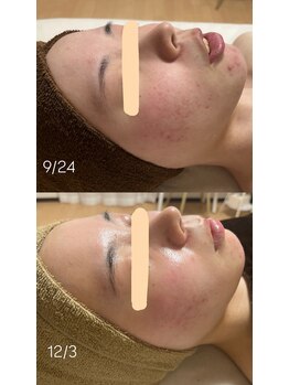 サロンモア(salon More)/陶肌トリートメン+LED