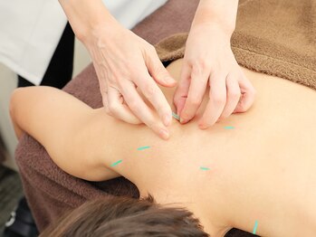 マチコ鍼灸院/はりをします