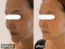 ココモンド(COCOMONDO)/幹細胞フェイシャル/エイジング