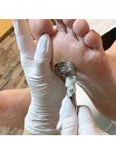 巻き爪補正店 鎌倉大船店/2.角質を取り除きます