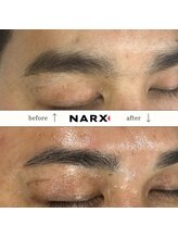 ナークス(NARX)/【眉毛脱毛】ビフォーアフター