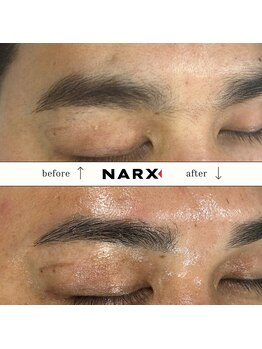 ナークス(NARX)/【眉毛脱毛】ビフォーアフター