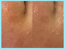 ハーブピーリング 名古屋/目尻のシワ改善♪ふっくらお肌に