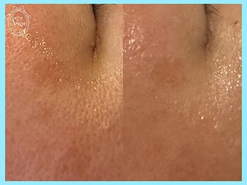 ハーブピーリング 名古屋/目尻のシワ改善♪ふっくらお肌に