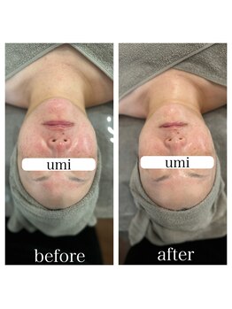 ウミ(umi)/一度でこの変化