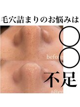 サロンツキ(salon tuki)/ハーブピーリング症例