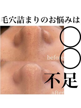 サロンツキ(salon tuki)/ハーブピーリング症例