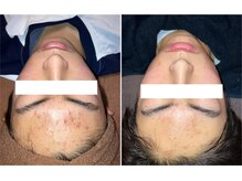 アネモネ ビューティーズ サロン(Anemone Beauty's salon)/ハーブピーリング Before→After