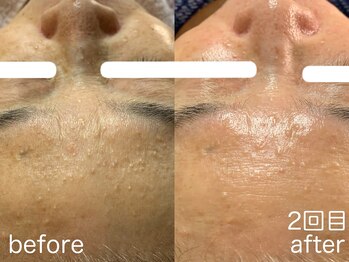 ハレオラ(HaleOla)/60代 素肌を育てる1stSTEP2回目