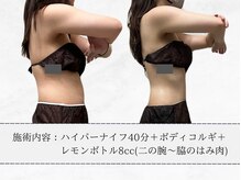 エメ(aimer)/レモンボトル《痩身・脂肪分解》