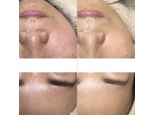 ビーダブリュー(BW...)/Eライト（光＋高周波）