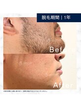 メンズクリア 上野店/【メンズクリア】お客様の施術例