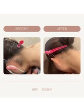 モアトゥインクル 山口店(MORE twinkle)/★症例写真★【10代】