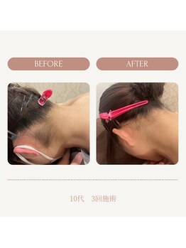 モアトゥインクル 山口店(MORE twinkle)/★症例写真★【10代】