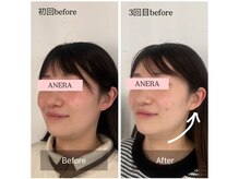 アネラ 難波(ANERA)/20代女性 たるみ/乾燥