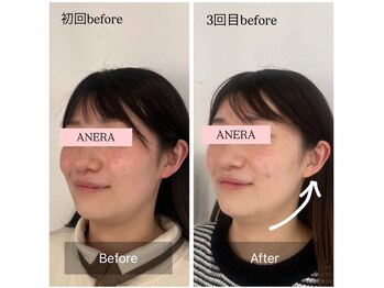 アネラ 難波(ANERA)/20代女性 たるみ/乾燥