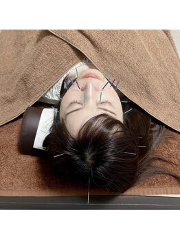 あとらす整体院 小岩店/美容鍼施術中。