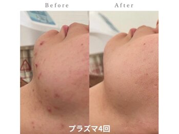 ホリホック/プラズマ症例