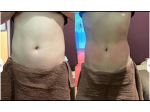 エターナルビューティ 都城店の雰囲気（例、、、施術3回の変化です。）