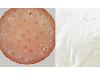 スマイルデイズ(Smiledays)/毛穴ケア　30代前半