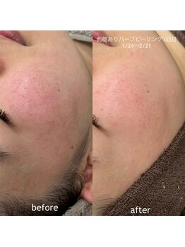 タグ 高知駅前店(Tug)/【頬の赤み・毛穴改善】剥離