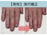 爪の形を変える【自爪育成再生】男性ハンド