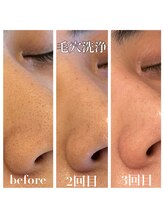 エピス(eps.)/毛穴洗浄ハイドラフェイシャル