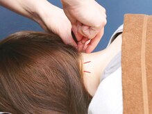 越谷ヘルム鍼灸整体院(越谷HELM鍼灸整体院)/首・肩こりにおススメな鍼施術◎