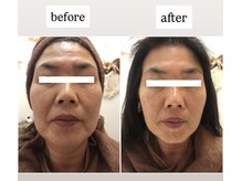 アランプスパ(ARNHP-Spa)/フェイシャルエステ