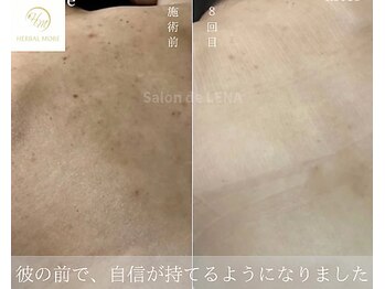 サロンドレナ 名駅店/ハーブピーリング サロンドレナ