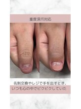 ティアラネイル 宇都宮/深爪矯正