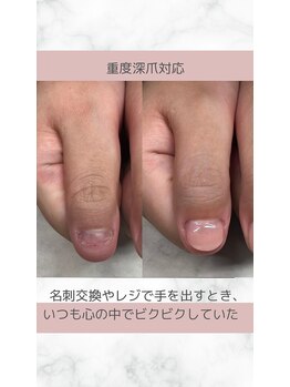 ティアラネイル 宇都宮/深爪矯正