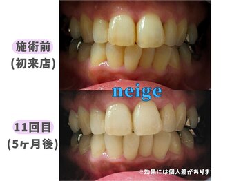 ネージュ(neige)/50代前半/女性/たばこ1日15本