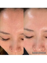 ラズ(Luz)/雪花ピール