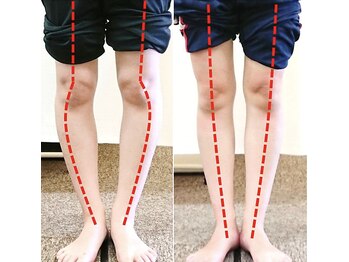 エール シガ(AILE SHIGA)の写真/脚のむくみ、スッキリ解消！スリム美脚★骨盤から下半身やせも◎【美脚・O脚矯正+骨盤矯正¥8800→¥2980!】