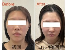 ビーキュート 姫路店(BE-CUTE)/小顔コルギ5回目