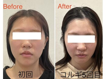 ビーキュート 姫路店(BE-CUTE)/小顔コルギ5回目