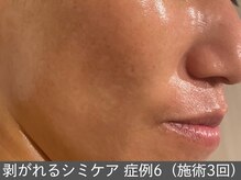 オアシスラグーン(OASIS LAGOON)/シミケア（症例6 施術3回）40代