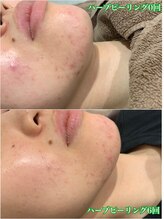 エリーザベル(Elisa Bell)/話題のハーブピーリング