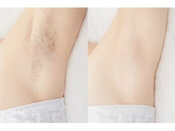 エイム(EIM)/セルフ脱毛