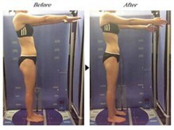 ビューティークリニックコダマ 日向店/【1か月コース】M.S様(25歳)