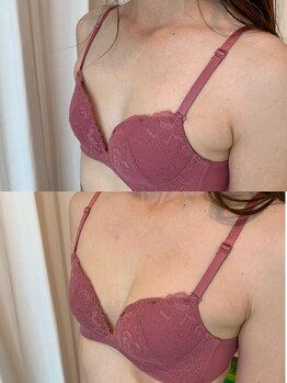 タオ(TAO)/バストアップ症例