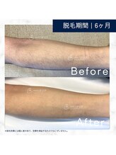 メンズクリア 上野店/【メンズクリア】お客様の施術例