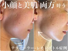 アリィ(Alii hisaya)の雰囲気（【テラボーラー×レモンボトル】加齢×脂肪どちらも悩む方に♪）