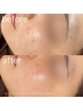 ルルラ リコ(lulula rico)/症例写真/ハーブピーリング