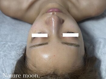 ナチュールムーン(Nature moon.)/ハーブピーリング after