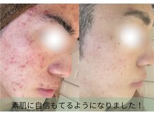 ポアレ(POARE)の雰囲気(ニキビを隠せない男性も清潔感と自信up!人生変わるモテ肌へ)